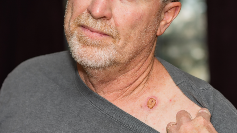 understanding skin cancer